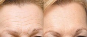 stress forehead wrinkles